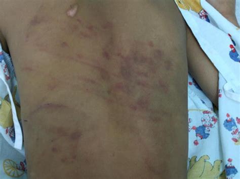 a) A bruise on a 2-month-old infant. . Belt marks on child